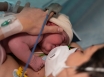 Testing and treating newborns for spinal muscular 